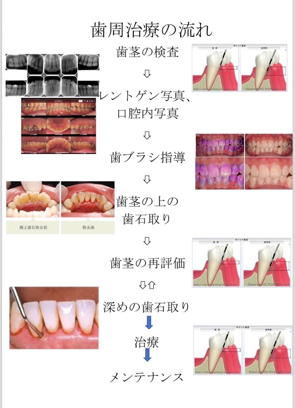 歯周治療の流れ