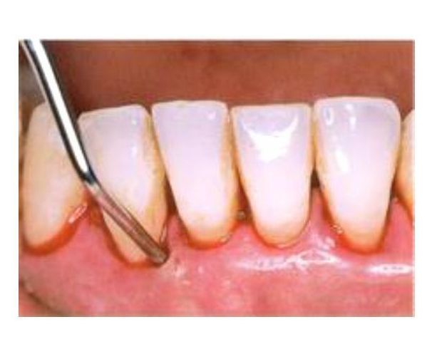 歯周治療１